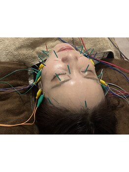 鍼灸施術を受けたい