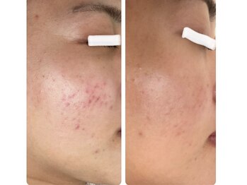 ルウス(Ruusu)/肌荒れが綺麗になった実績多数！