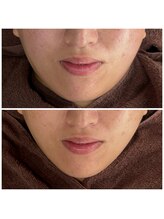 カラット(CARAT)/光フェイシャル