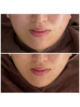 カラット(CARAT)/光フェイシャル