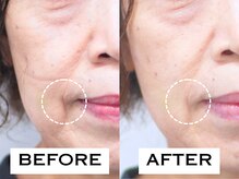 ビハリスト 新宿マルイ本館/口元のシワが改善！