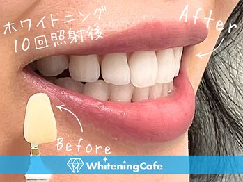 ホワイトニングカフェ 盛岡大通店(WhiteningCafe)/◎歯のホワイトニング施術写真◎