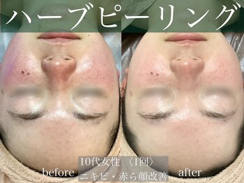 モア 多治見店(MORE)/ハーブピーリング♪