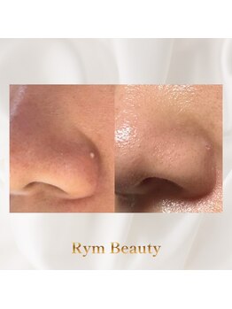 リム ビューティー(RYM BEAUTY)/ニキビケア