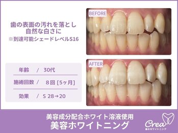 クレア(Crea)/【ホワイトニング症例写真】