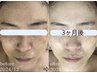 人気3【鎮静&活性】抗酸化×守りの白スピア♪水滴LDM×白雪タラソ5g