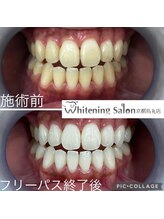 ホワイトニングサロン 京都烏丸店/ホワイトニング施術例