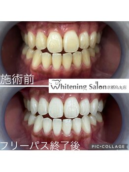 ホワイトニングサロン 京都烏丸店/ホワイトニング施術例