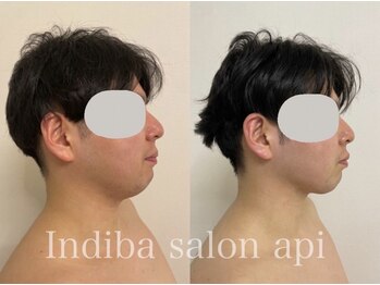 アピ(api)/症例写真【インディバ】