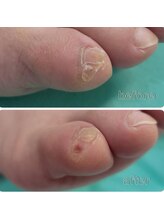 巻き爪補正店 つくば店/【副爪ケア】