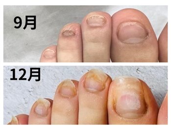 グレースレディ/フットの重いむしり癖の方