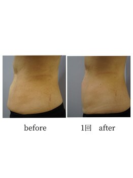 アップルミント/＜痩身＞before・after