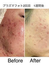 ビューティーサロン ルクール エステ(beauty salon le Coeur Este)/NEW☆プラズマフォト美顔