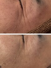 イディアル(IDE'AL)/陶肌トリートメント