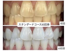 ホワイトニングショップ 明石大久保店/【BeforeAfter】10回券のお客様