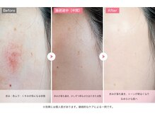 ルシェンテ 鈴鹿(Lucente)/ダクトピール経過5回　40代女性