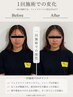 【初めての美容鍼に】小顔美容鍼