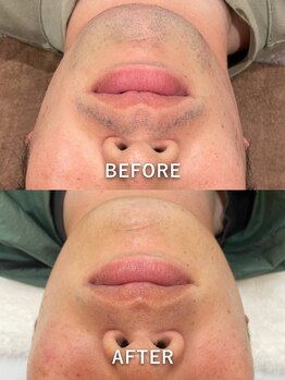 ルコア ドゥ(rucor doux)/メンズおヒゲ脱毛