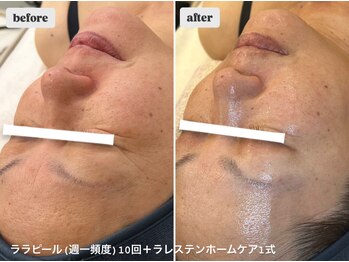 ユマニ バイ ヒート(Humani by HEAT)/本気の肌質改善