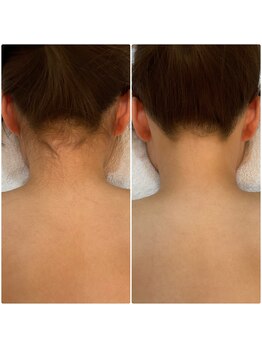 プレヴェール 神戸三宮/うなじ+背中脱毛