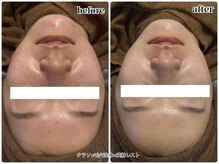 エンチャント(ENCHANT)/黒ずみ、赤み、ひらき、くすみ★