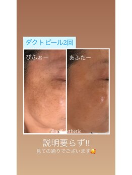 ノフ 恵比寿(noff)/bf/af【ダクトピール】