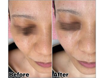 ベルミーランド MEGAドン・キホーテ草加/エステダーマBefore→After