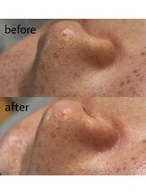 ヴィシアス(VIXIAS)/肌管理/毛穴洗浄