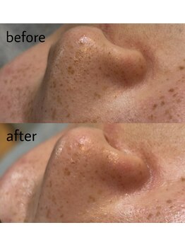 ヴィシアス(VIXIAS)/肌管理/毛穴洗浄