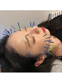 ビープラス(BEE PLUS)の写真/【小顔効果即実感!!】そのエラ実は筋肉のせいかも？美容鍼でキュッとフェイスライン(鍼＋EMS機械)¥4980♪