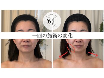 サロンドソエ(Salon de Soe)/フェイシャル&ハーブピーリング