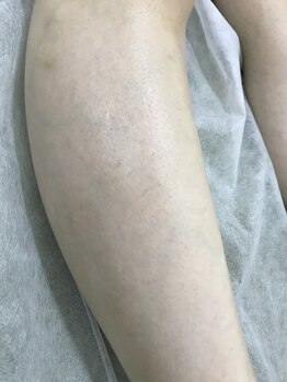 ナノハナ/鹿沼市本格全身脱毛ナノハナ