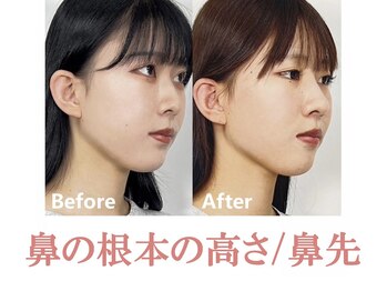 ラプリエイル 千葉店(Raplit aile)/ 隆鼻+輪郭矯正40分10回