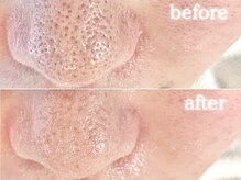 メモリ/施術１回による鼻の黒ずみの変化