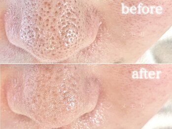 メモリ/施術１回による鼻の黒ずみの変化