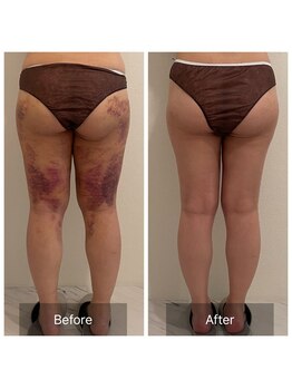 デッサン(dessin)/内出血やむくみの軽減ケア!