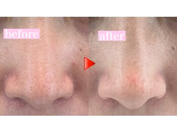 エミナル(eminal)/ビフォー/アフター/毛穴/梅田