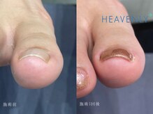 ヘブンリープラス＋ Luz湘南辻堂店/巻き爪補正 矯正 フットケア