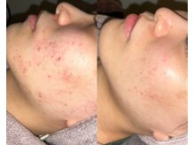 ル シーニュ/プロセル×2回