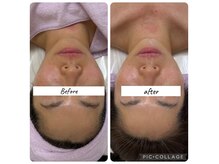 ルピナージュ(Lupinage)の雰囲気（【フェイスラインすっきり/ハリ弾力UP】ACフェイシャル）