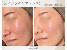 スリースリー 恵比寿(THREE THREE)/エイジングケア・しわ・たるみ