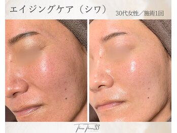 スリースリー 恵比寿(THREE THREE)/エイジングケア・しわ・たるみ