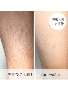 ココスターリー 香椎店(Coco starry)/男性・照射2回☆1ヶ月後
