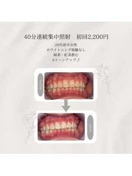 プラスビーセルフ(+b self)/ホワイトニングビフォーアフター