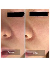 ラビ(RABBI)/20代女性毛穴洗浄コース