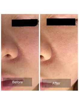 ラビ(RABBI)/20代女性毛穴洗浄コース