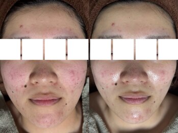 リボーン(REBORN)/ハーブピーリング