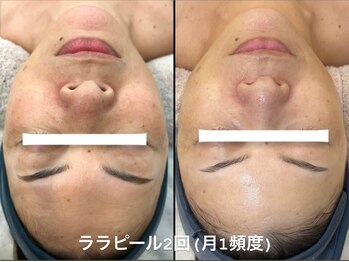 ユマニ バイ ヒート(Humani by HEAT)/最強エイジングケア！ララピール