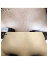 ピリナ 名古屋/【背中ハーブピーリング】症例