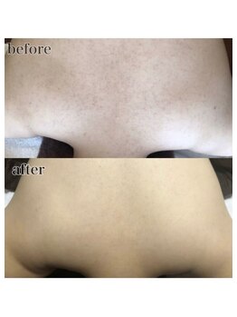 ピリナ 名古屋/【背中ハーブピーリング】症例